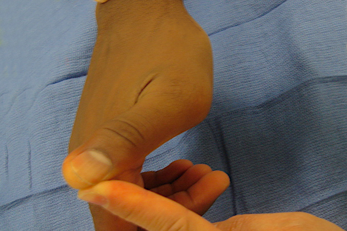 sprain-thumb-mp-joint-radial-collateral-ligament-hand-surgery-resource